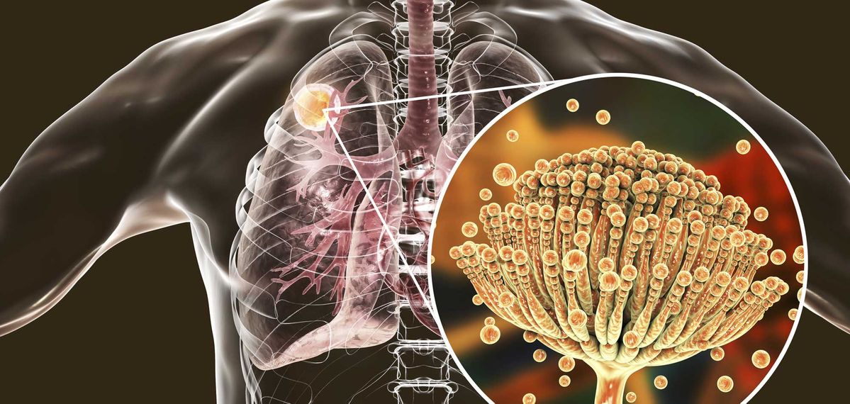 Bio - System GbR in Paderborn, Aspergillom der Lunge und Nahaufnahme Aspergillus-Pilze, Illustration 3D. Auch bekannt als Mycetom oder Pilzball, eine Läsion, die von Pilzen wie Aspergillus bei immungeschwächten Patienten verursacht wird